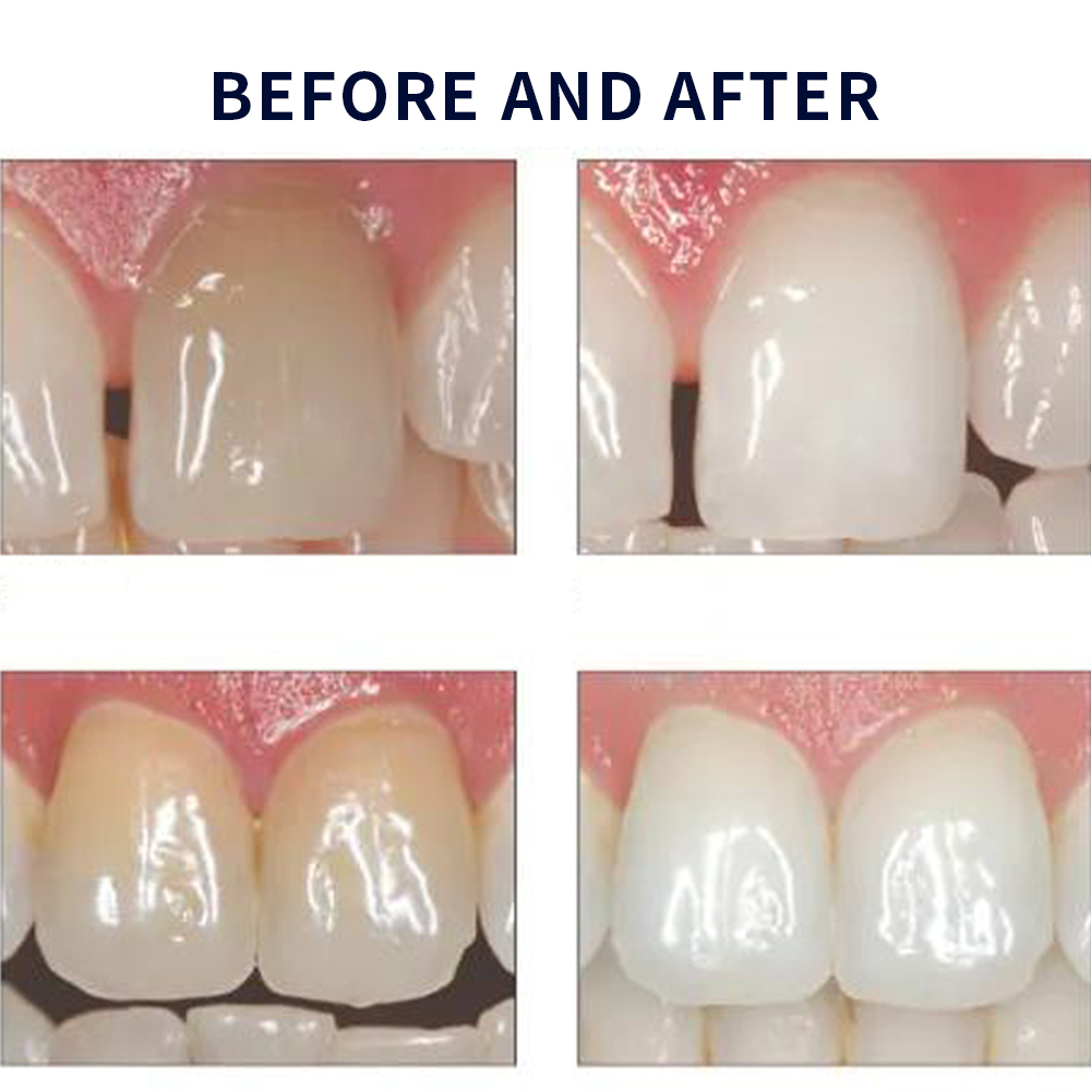 유백광 미백 20% PF 20 16 젤 키트, 초강력  - Teeth Whitening Bleaching Kit 리뷰 및 가격