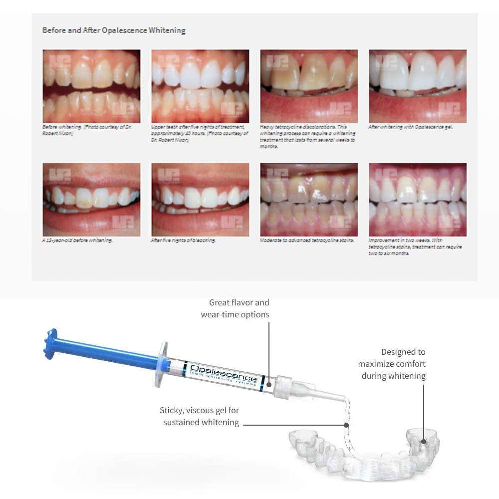 유백광 미백 20% PF 20 16 젤 키트, 초강력  - Teeth Whitening Bleaching Kit 리뷰 및 가격