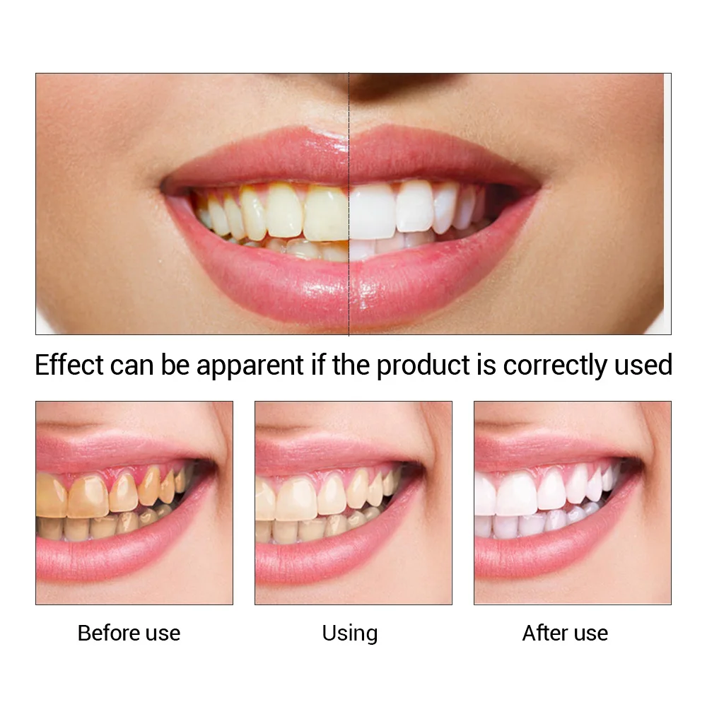 FTEENPLY 치아 미백 에센스 파우더 구강 위생 청 - Teeth Whitening Remedies 리뷰 및 가격