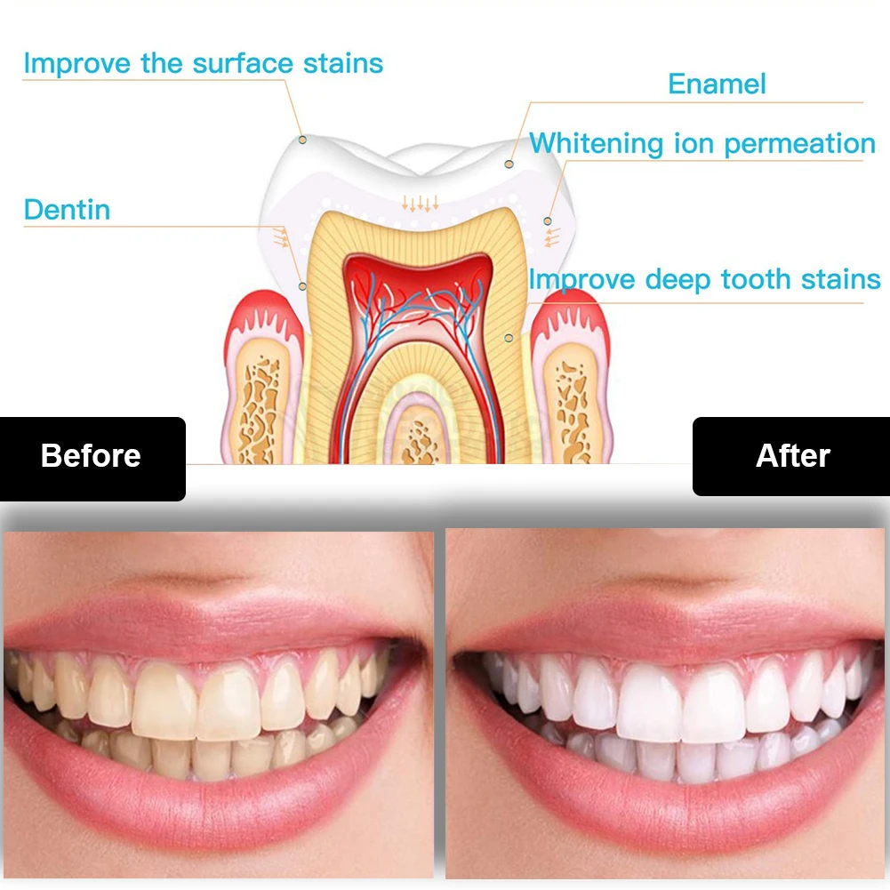 치과 치아 미백 키트 미니 16 LED 콜드 라이트 3 - Teeth Whitening Bleaching Kit 리뷰 및 가격